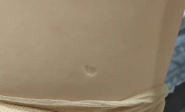 求助 手指甲碰到硅胶了，大腿出了个坑，怎么补